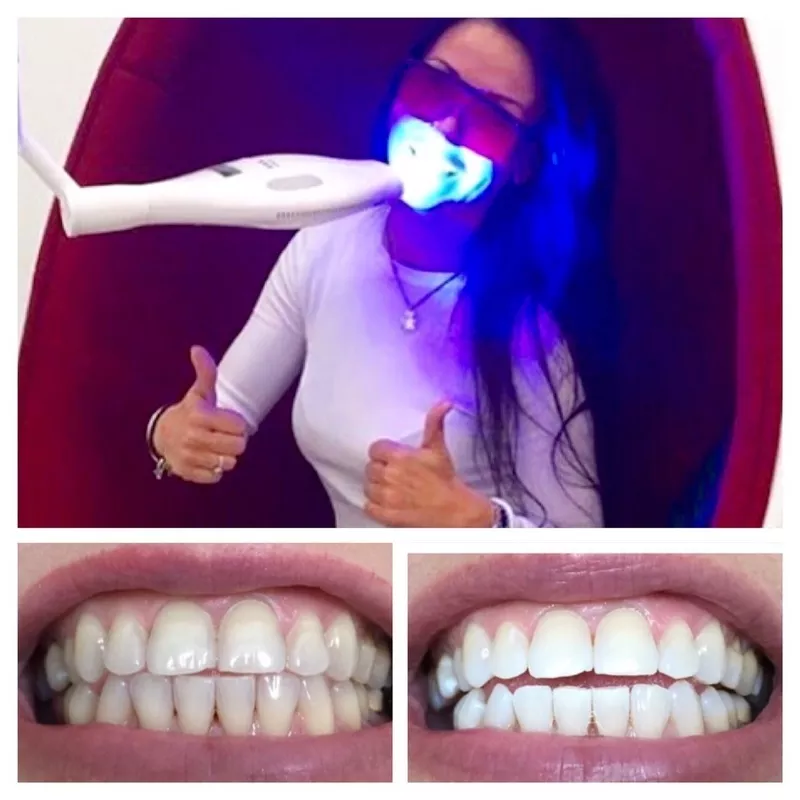 Косметическое отбеливание зубов в витебске 3